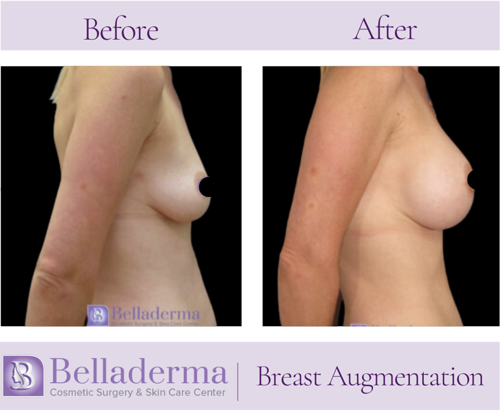 Breast Augmentation Before and After