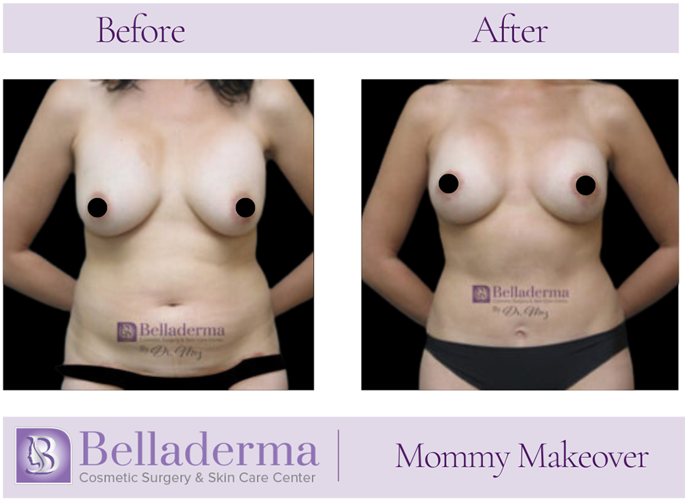 Mommy Makeover Before and After