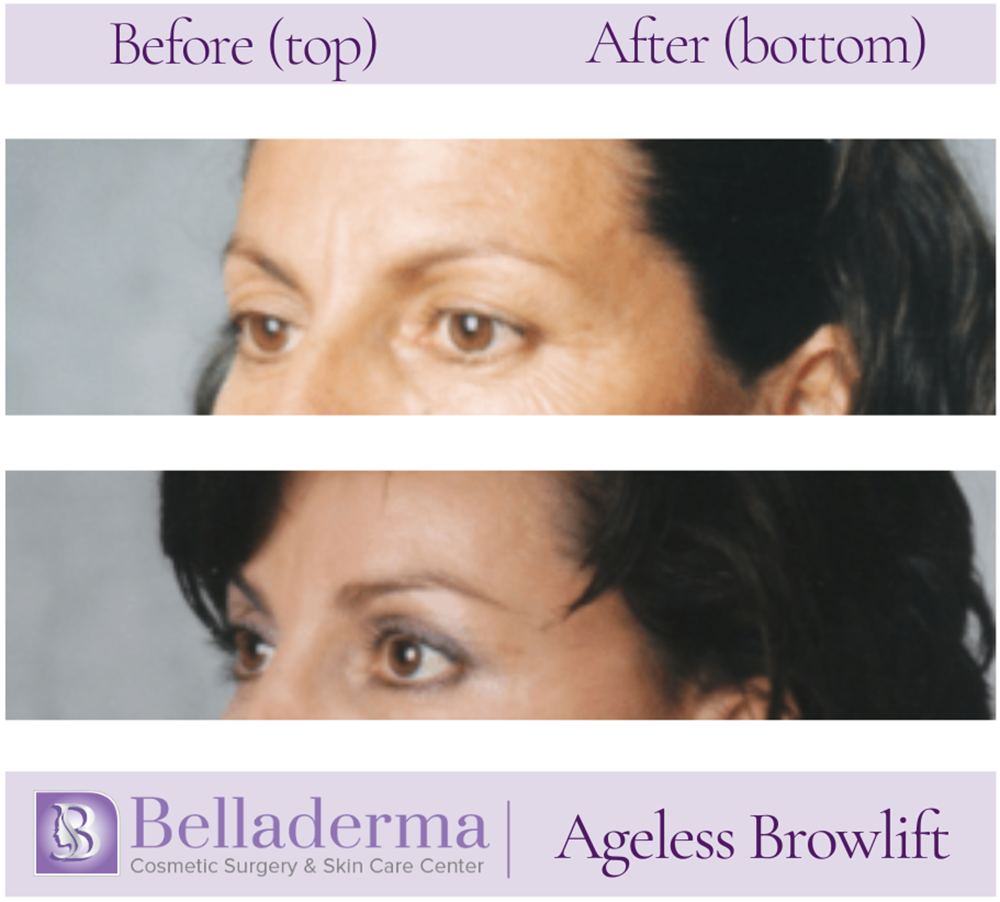 Brow Lift and Eyelid Lift Before and After