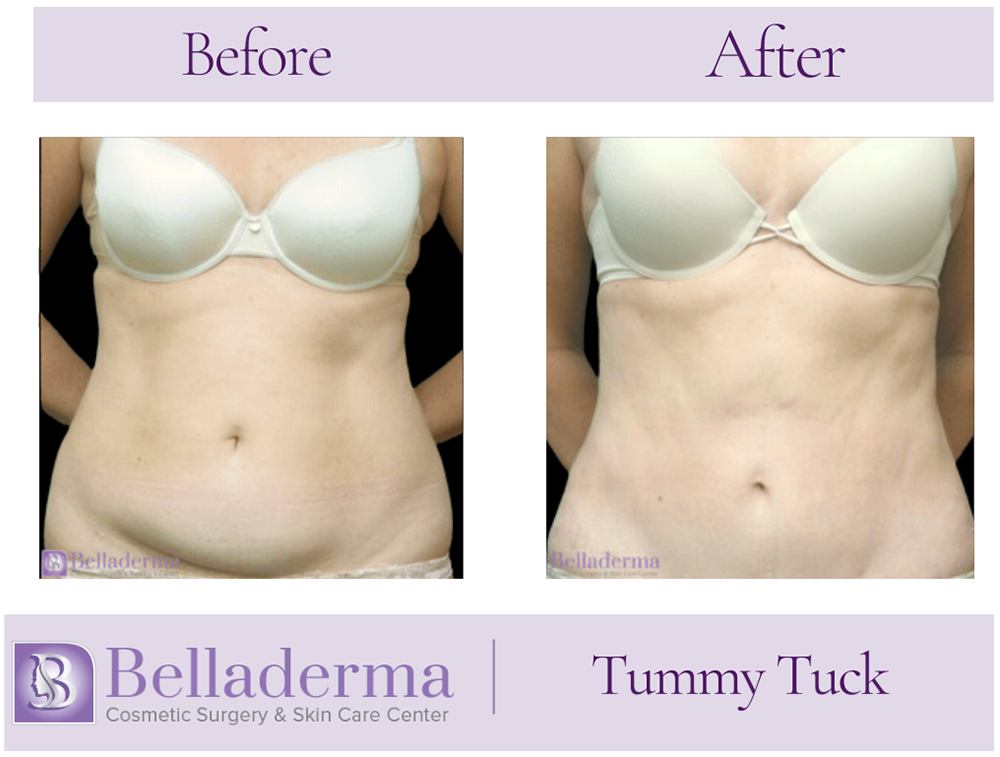 2 Tummy Tuck (abdominoplasty) Before and After