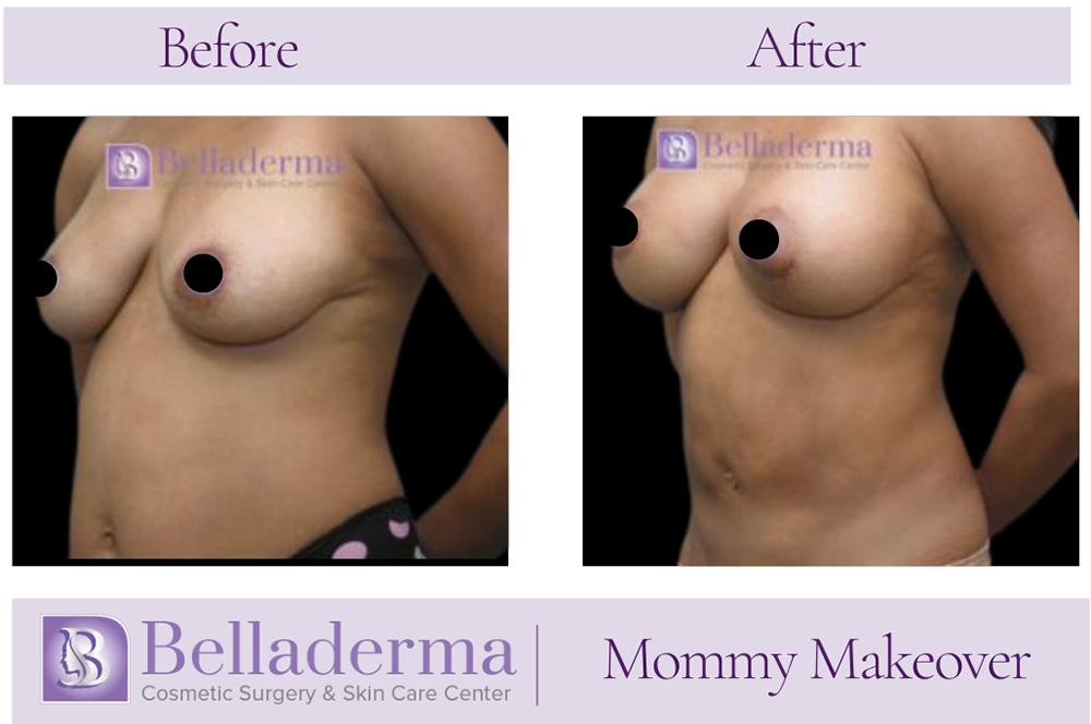 Mommy Makeover Before and After