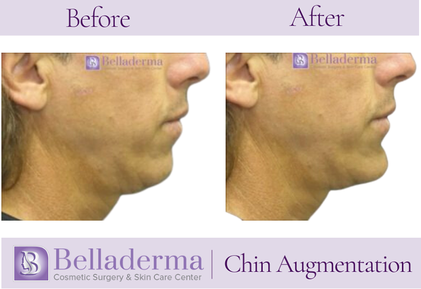 Chin Augmentation Before and After