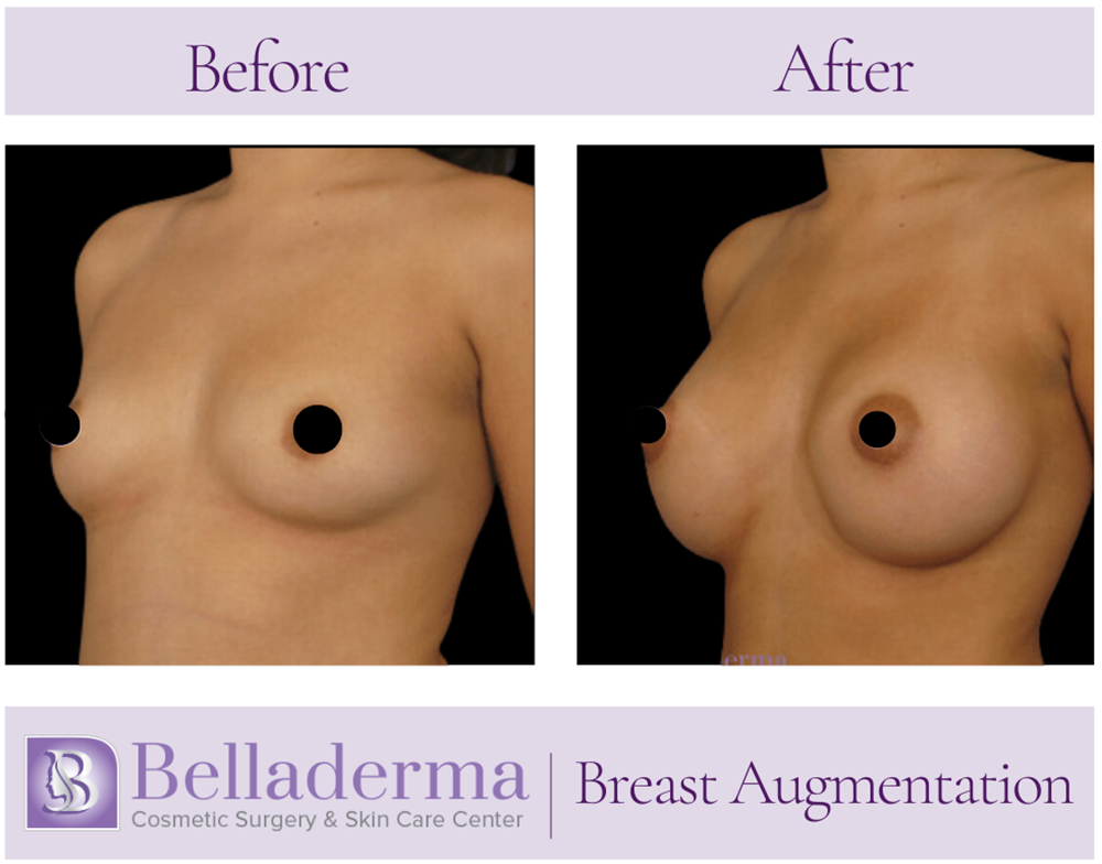 Breast Augmentation Before and After