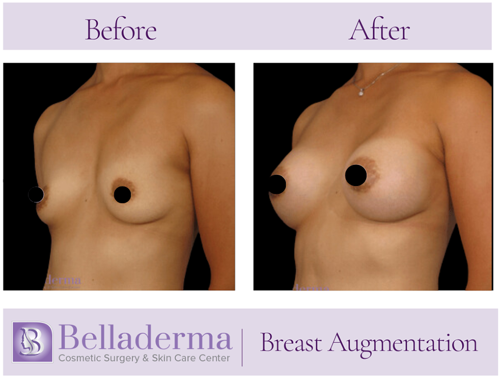 Breast Augmentation Before and After