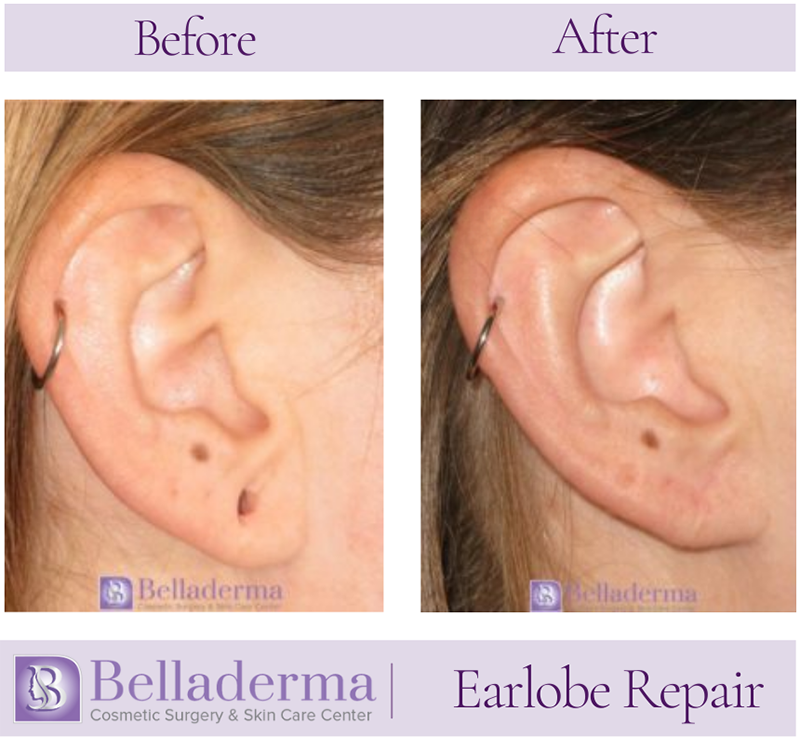 Earlobe Repair Before and After