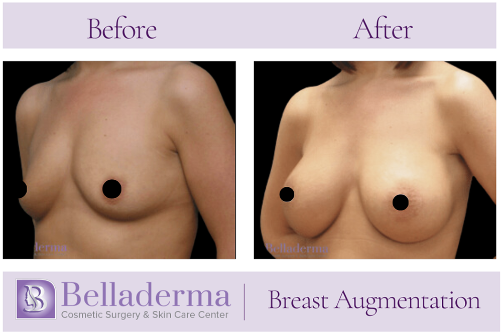 Breast Augmentation Before and After