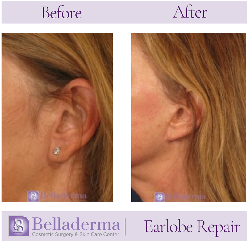 Earlobe Repair Before and After