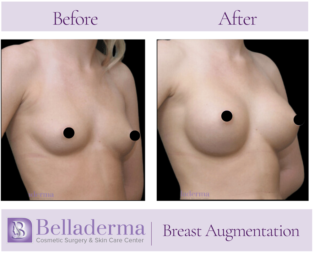 Breast Augmentation Before and After