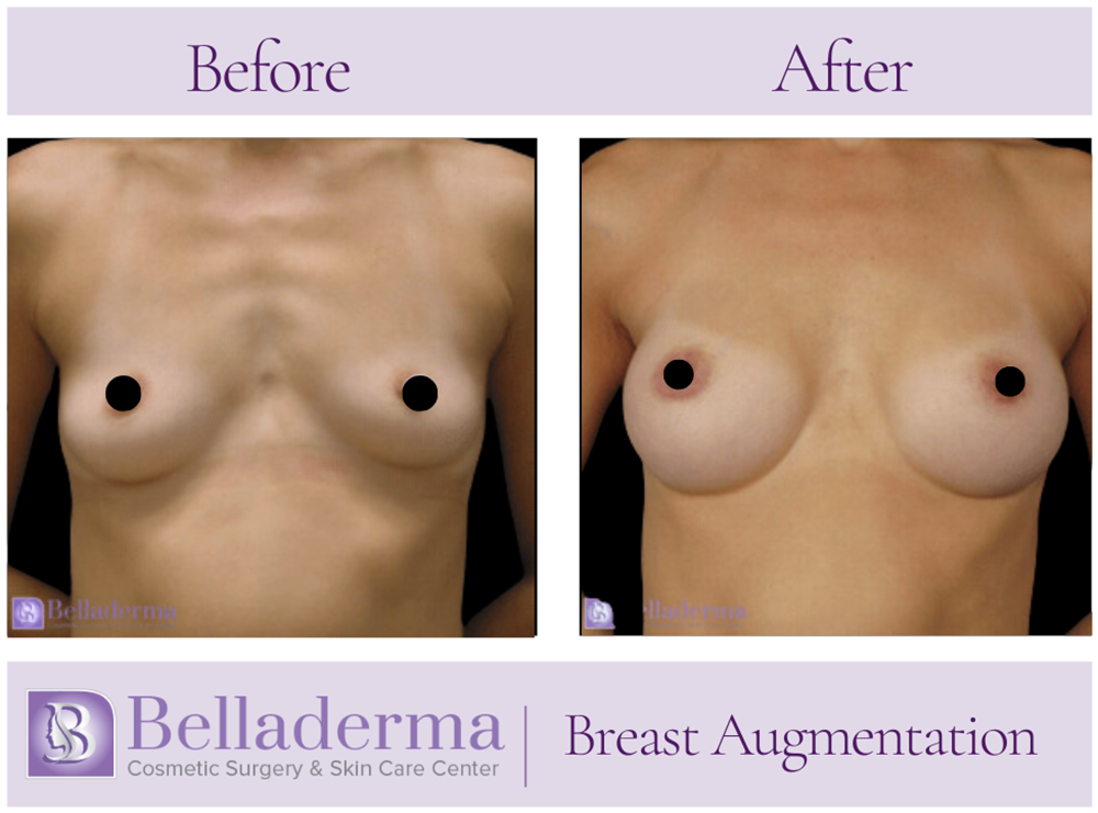 Breast Augmentation Before and After