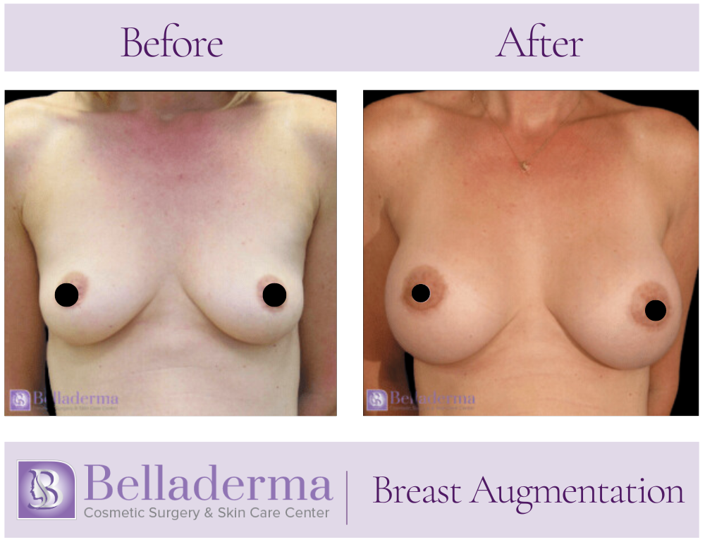 Breast Augmentation Before and After