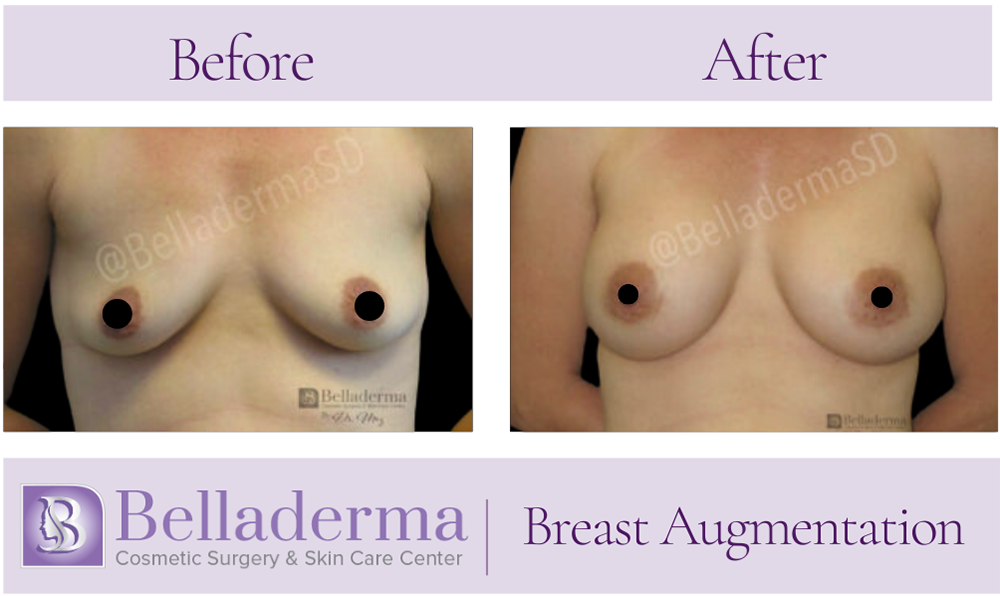 Breast Augmentation Before and After