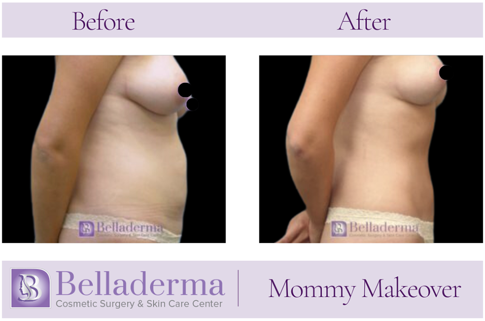 3 (2) Mommy Makeover Before and After