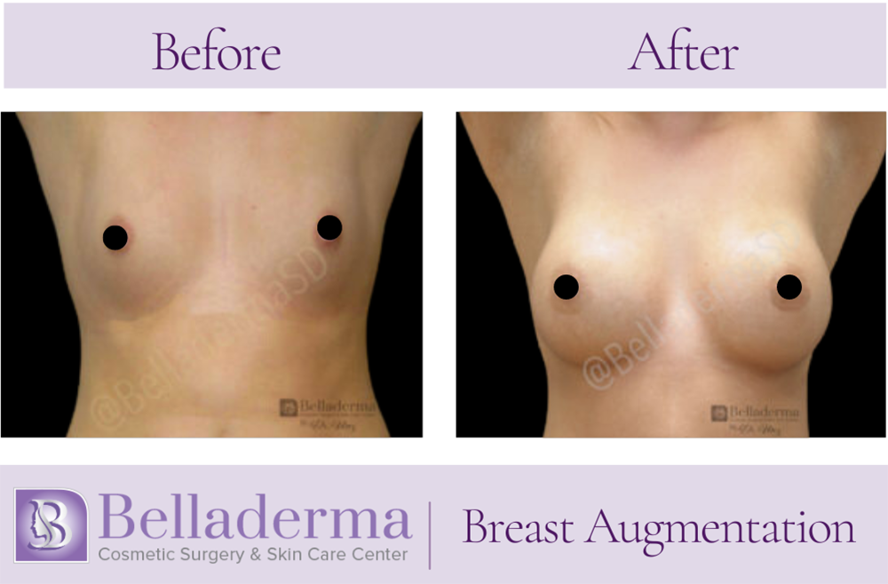 Breast Augmentation Before and After