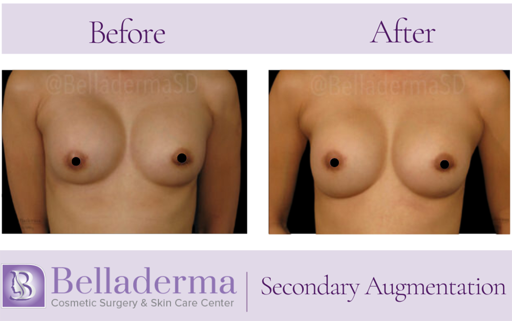 Breast Augmentation Before and After