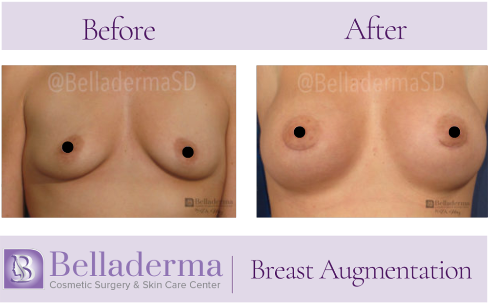 Breast Augmentation Before and After