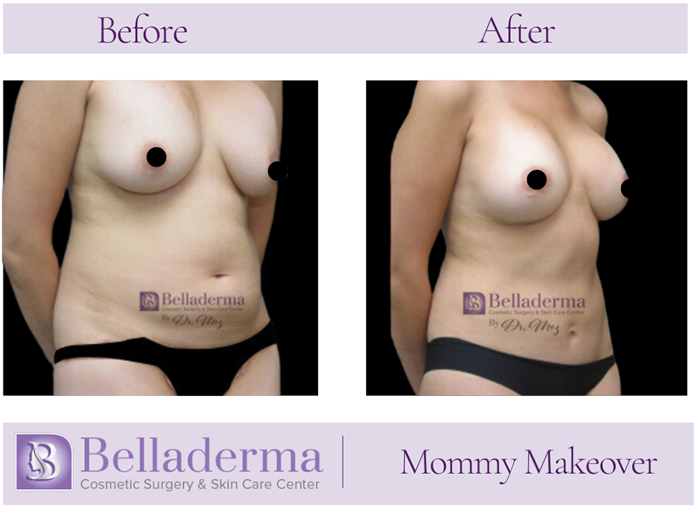 Mommy Makeover Before and After