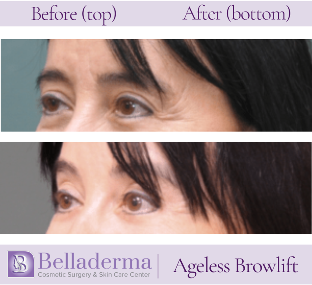 Brow Lift and Eyelid Lift Before and After