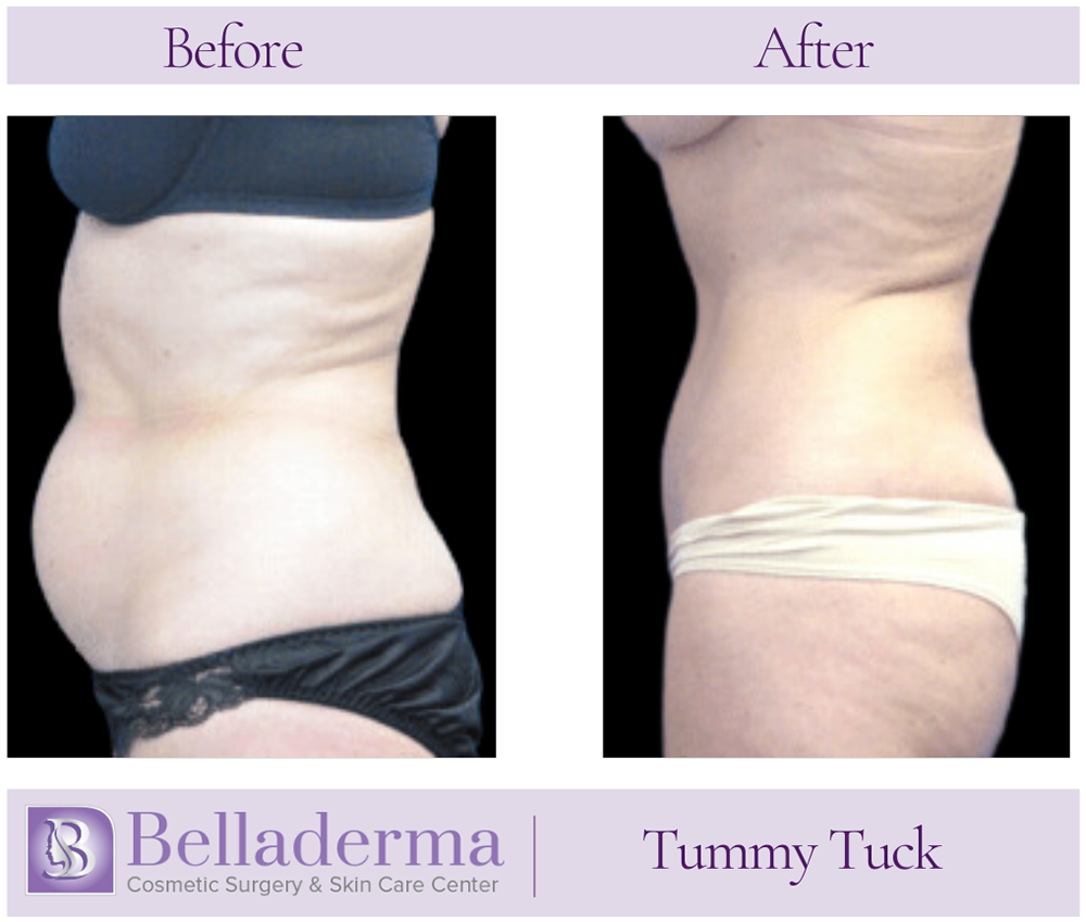 3 Tummy Tuck (abdominoplasty) Before and After