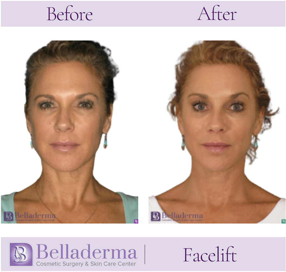 Belladerma Mini Facelift™ Before and After