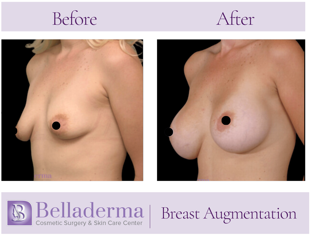 Breast Augmentation Before and After