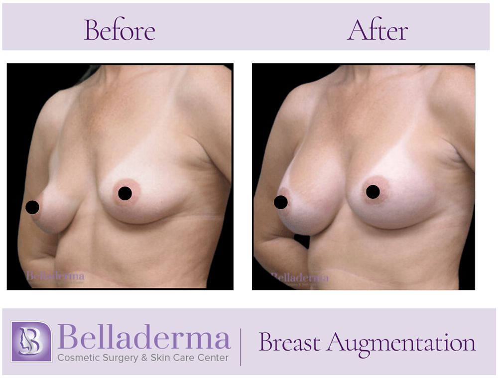 Breast Augmentation Before and After