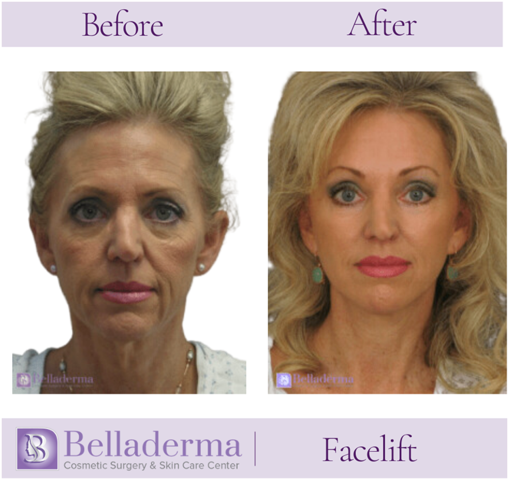 Belladerma Mini Facelift™ Before and After