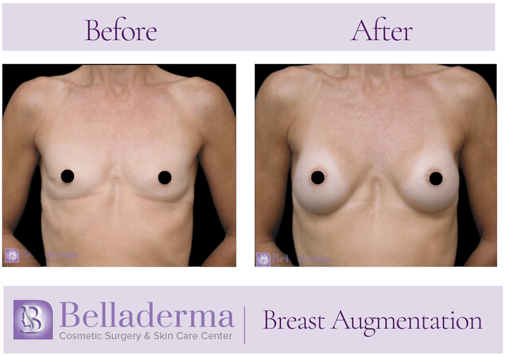 Breast Augmentation Before and After