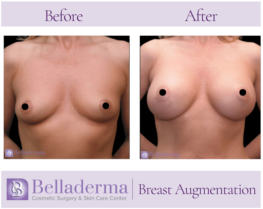 Breast Augmentation Before and After