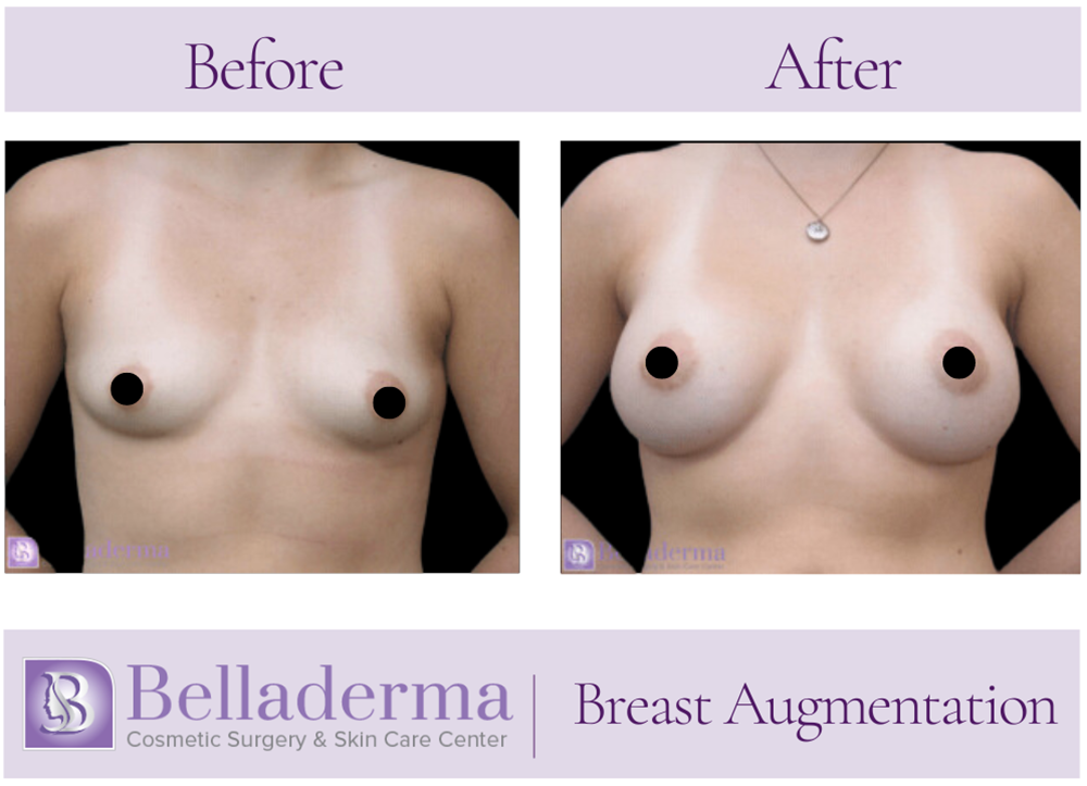 Breast Augmentation Before and After