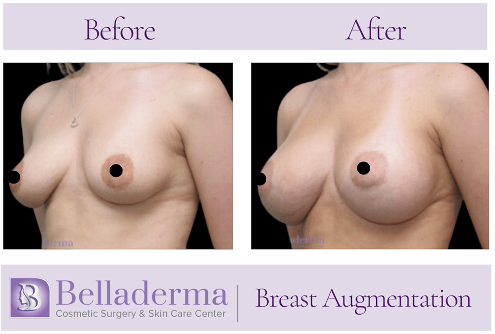 Breast Augmentation Before and After