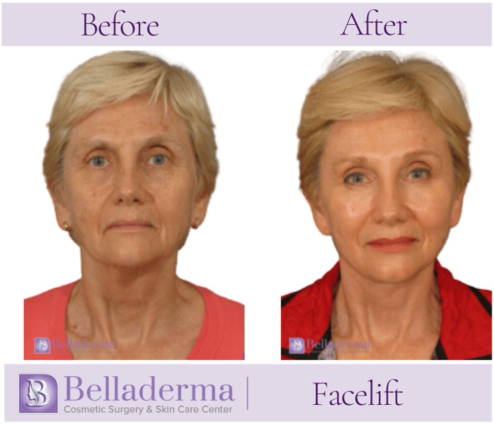 Belladerma Mini Facelift™ Before and After