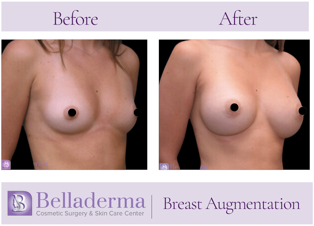 Breast Augmentation Before and After