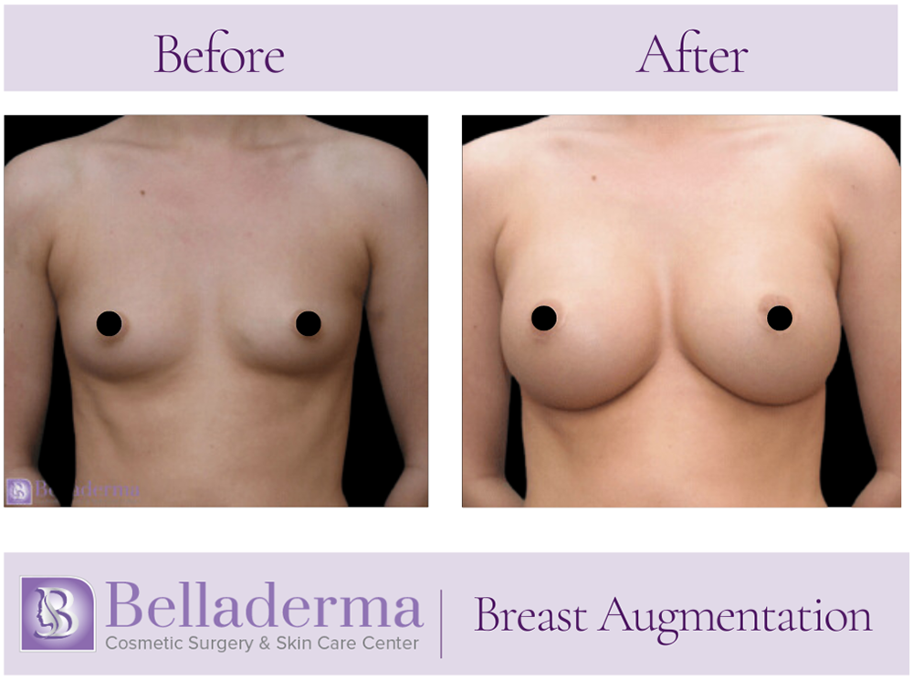 Breast Augmentation Before and After