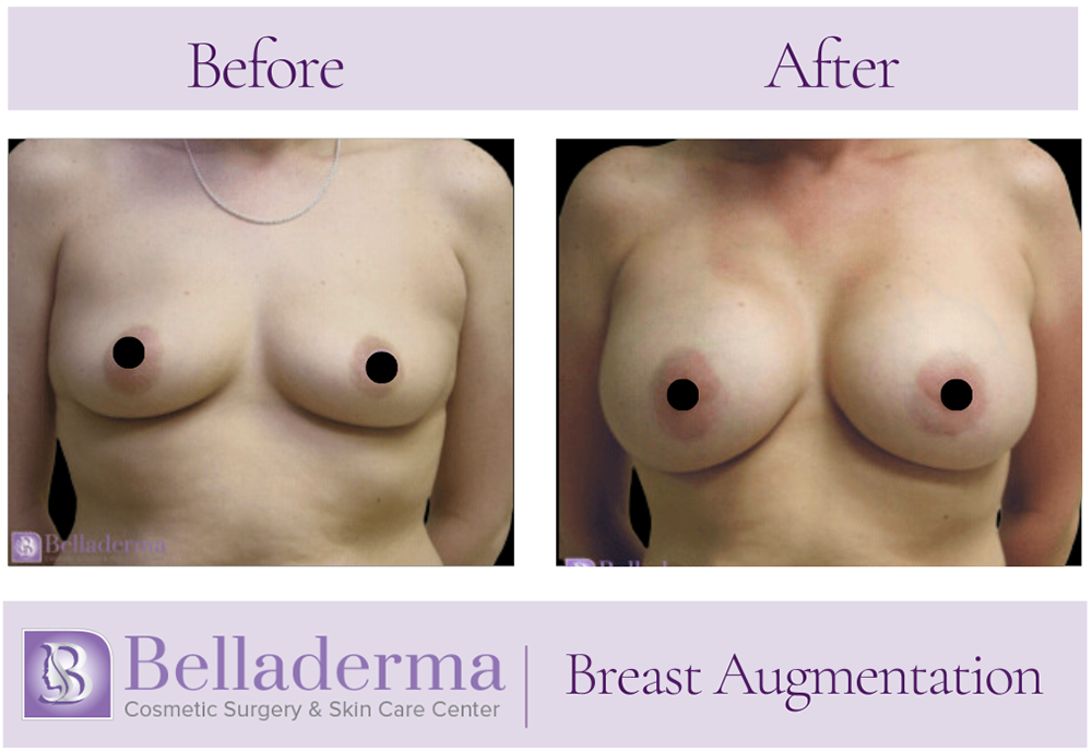 Breast Augmentation Before and After