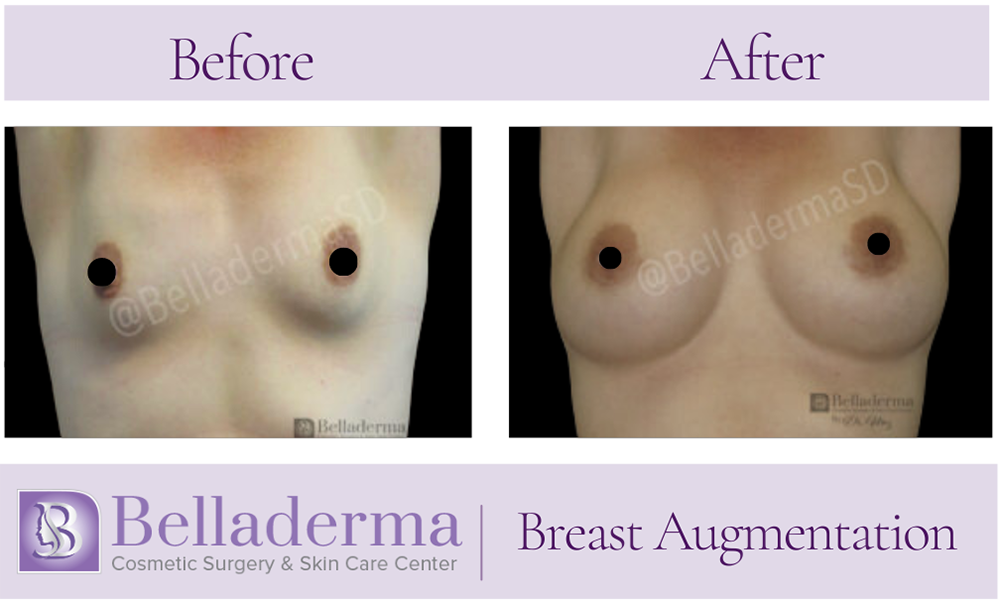 Breast Augmentation Before and After