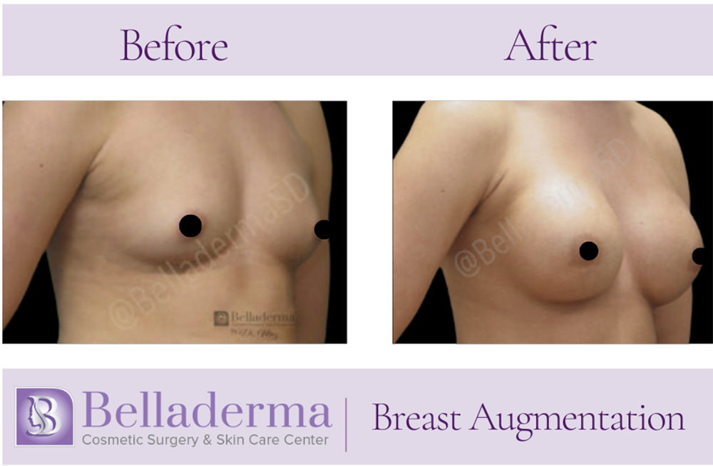 Breast Augmentation Before and After