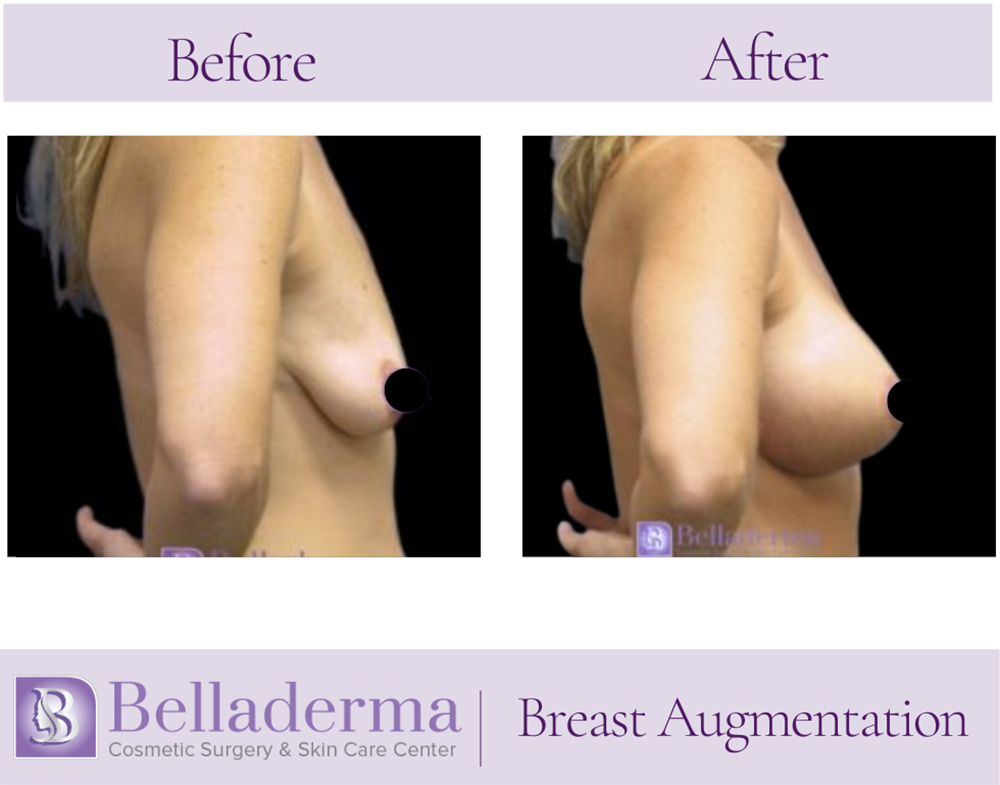 Breast Augmentation Before and After