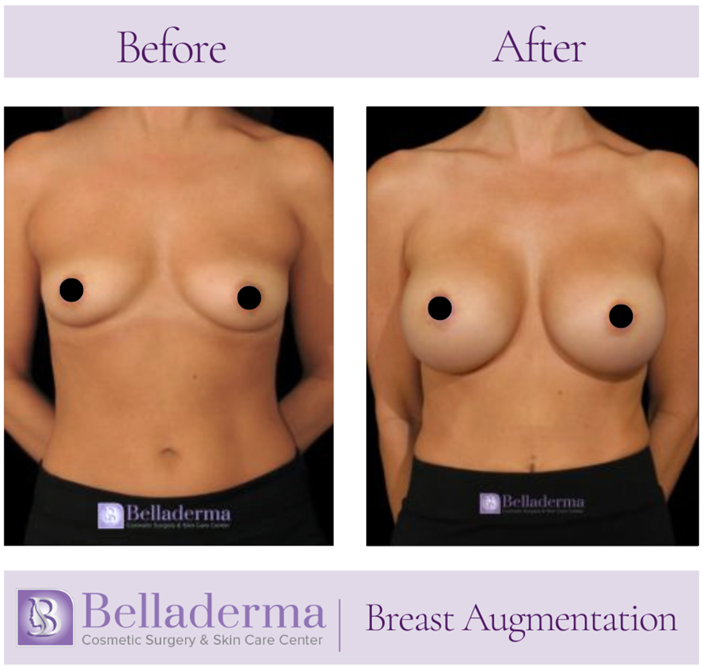 Breast Augmentation Before and After