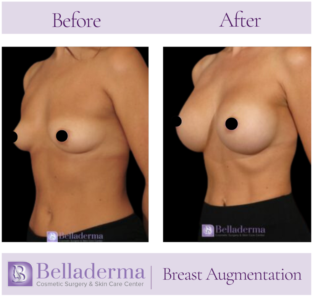 Breast Augmentation Before and After