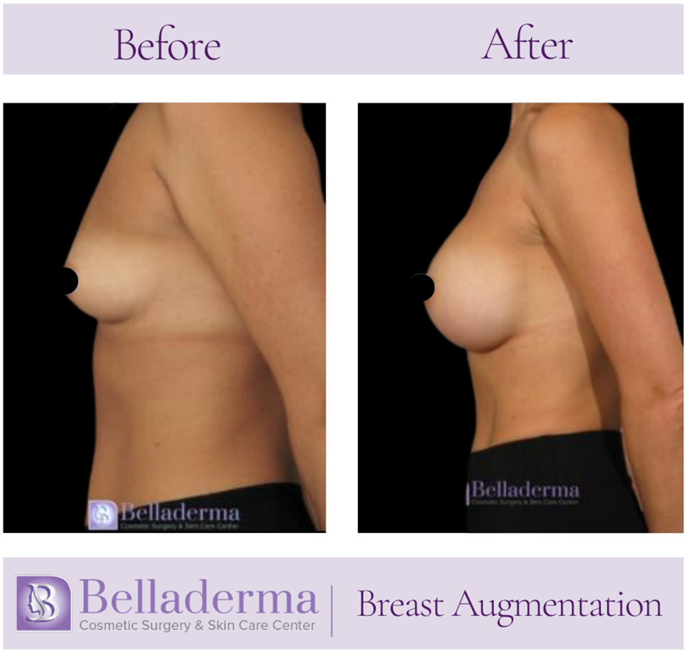 Breast Augmentation Before and After