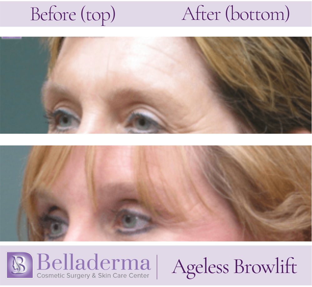 Brow Lift and Eyelid Lift Before and After