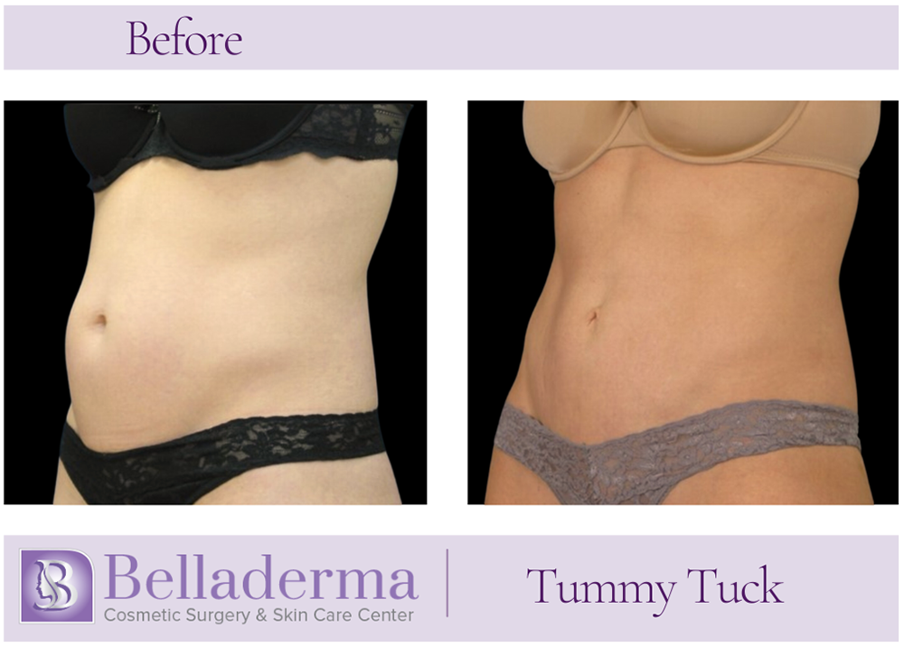 Tummy Tuck (abdominoplasty) Before and After
