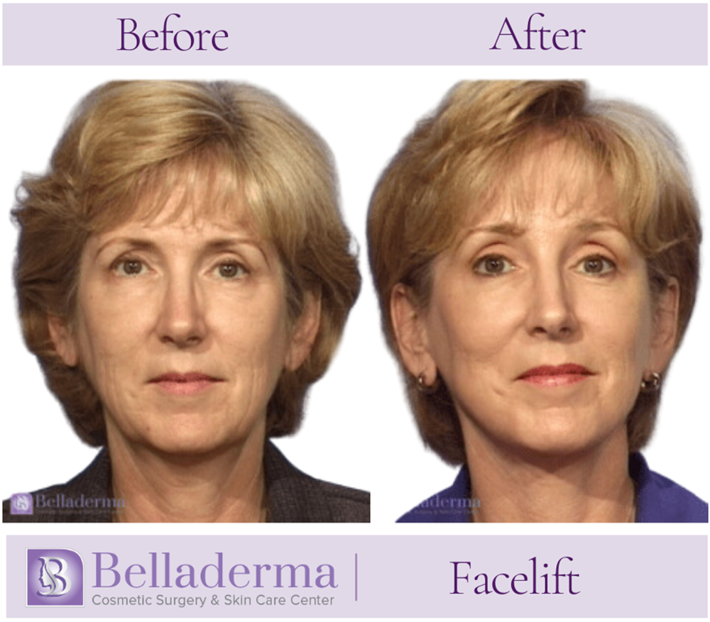 Belladerma Mini Facelift™ Before and After