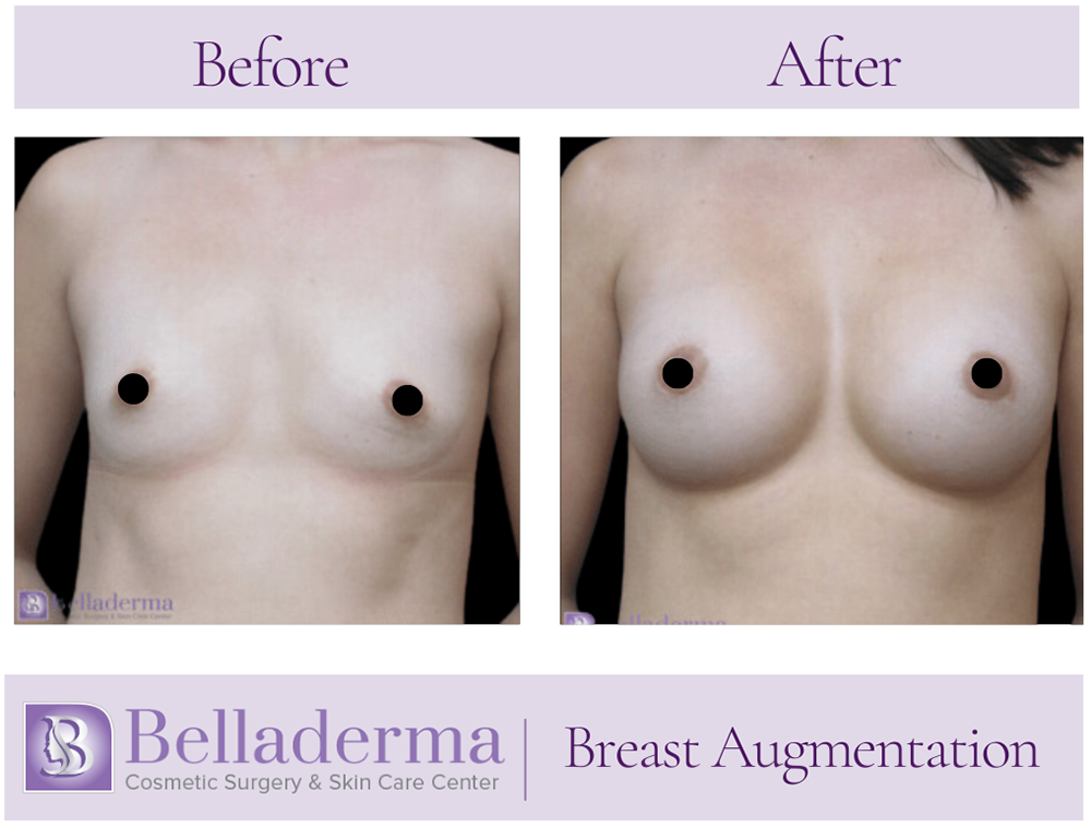 Breast Augmentation Before and After