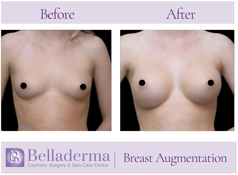 Breast Augmentation Before and After