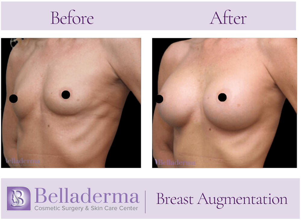 Breast Augmentation Before and After