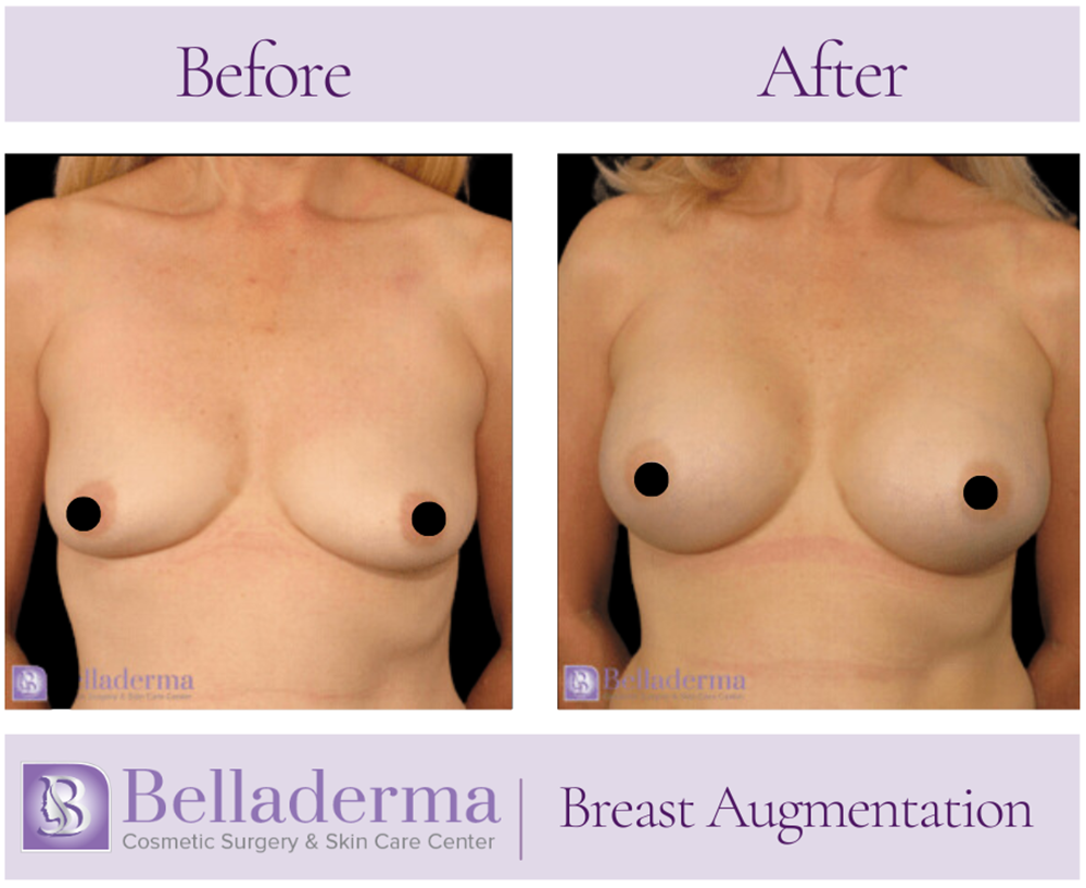 Breast Augmentation Before and After