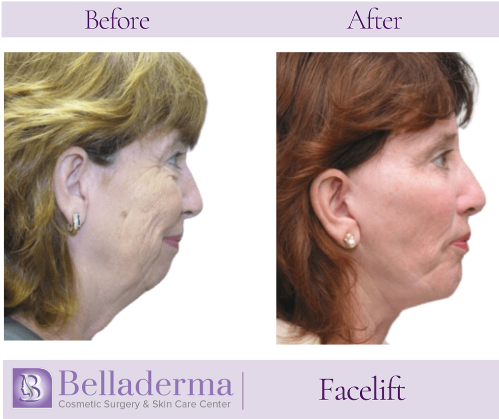 Belladerma Mini Facelift™ Before and After