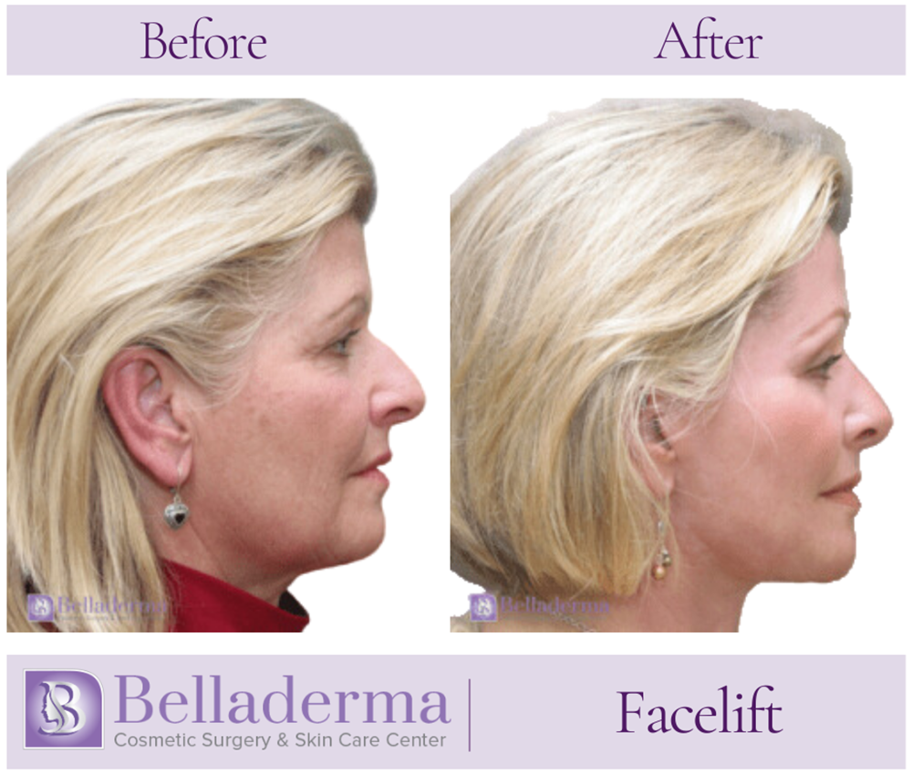 Belladerma Mini Facelift™ Before and After