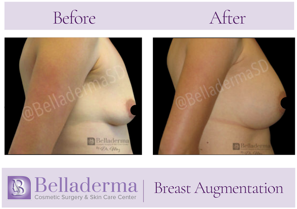 Breast Augmentation Before and After